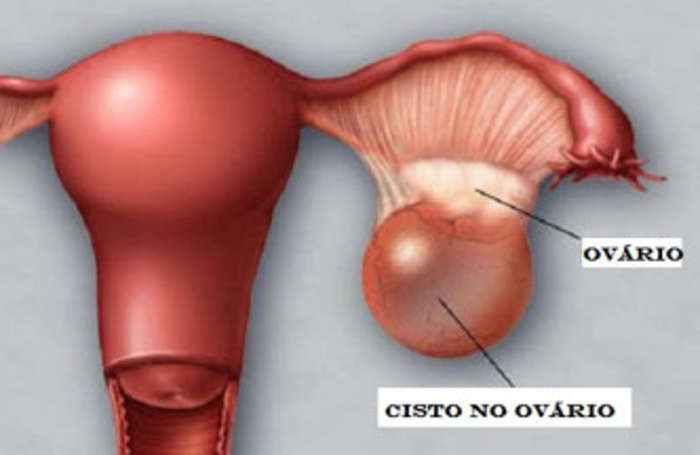 Cisto no ovário pode prejudicar fertilidade